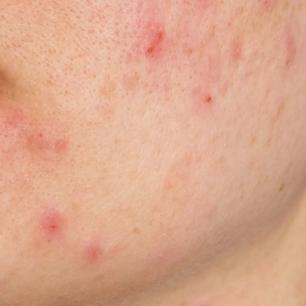 Crema Facial Anti acné | Acni G