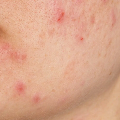 Jabón Facial Anti acné | Acni G