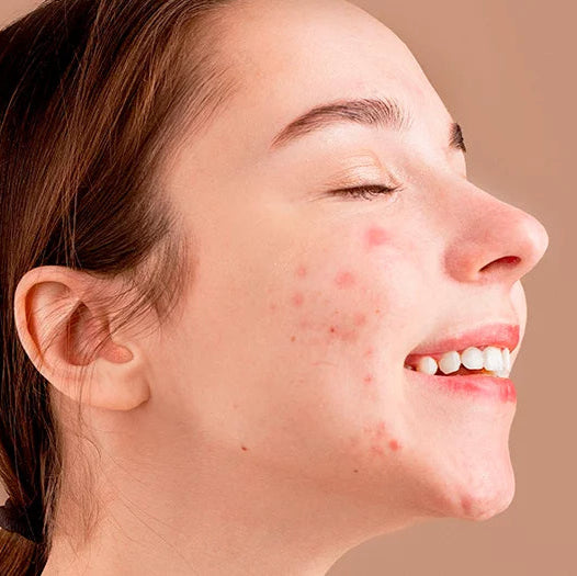 Sérum Anti acné | Acni G Max